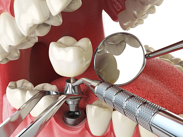 Best Emergency Dentist for Knocked-Out Tooth in Carson City, MI